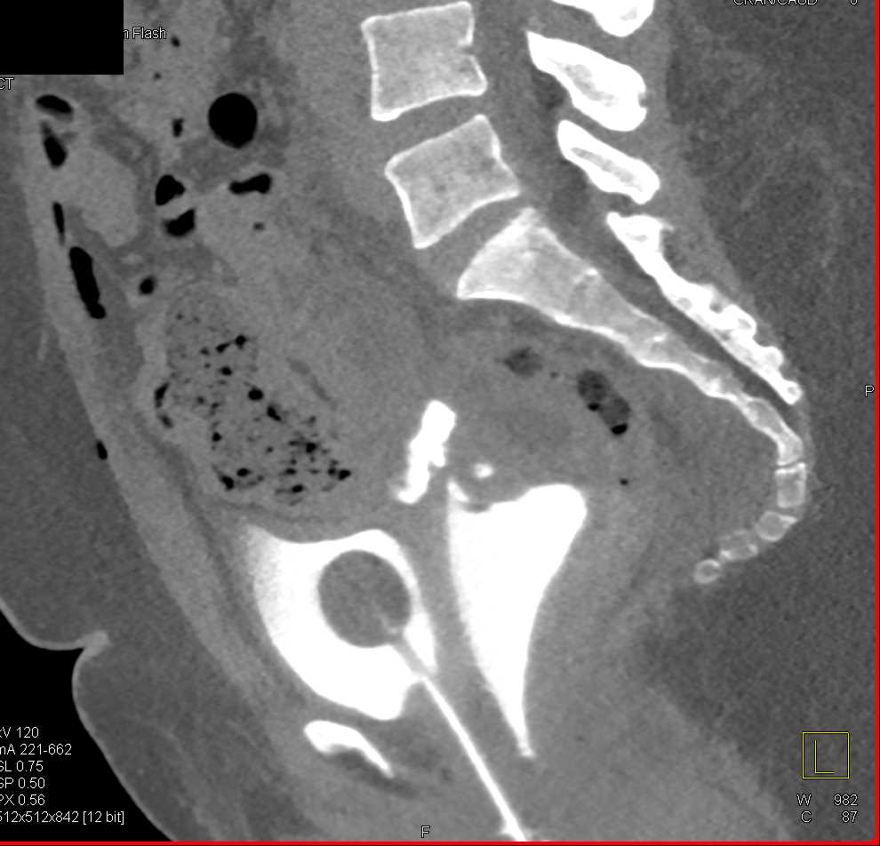 Fistulae from Bladder to Cervix on a CT Cystogram - CTisus CT Scan