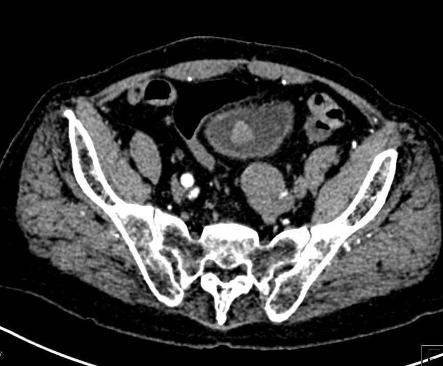 Bladder Cancer in the Dome of the Bladder - CTisus CT Scan
