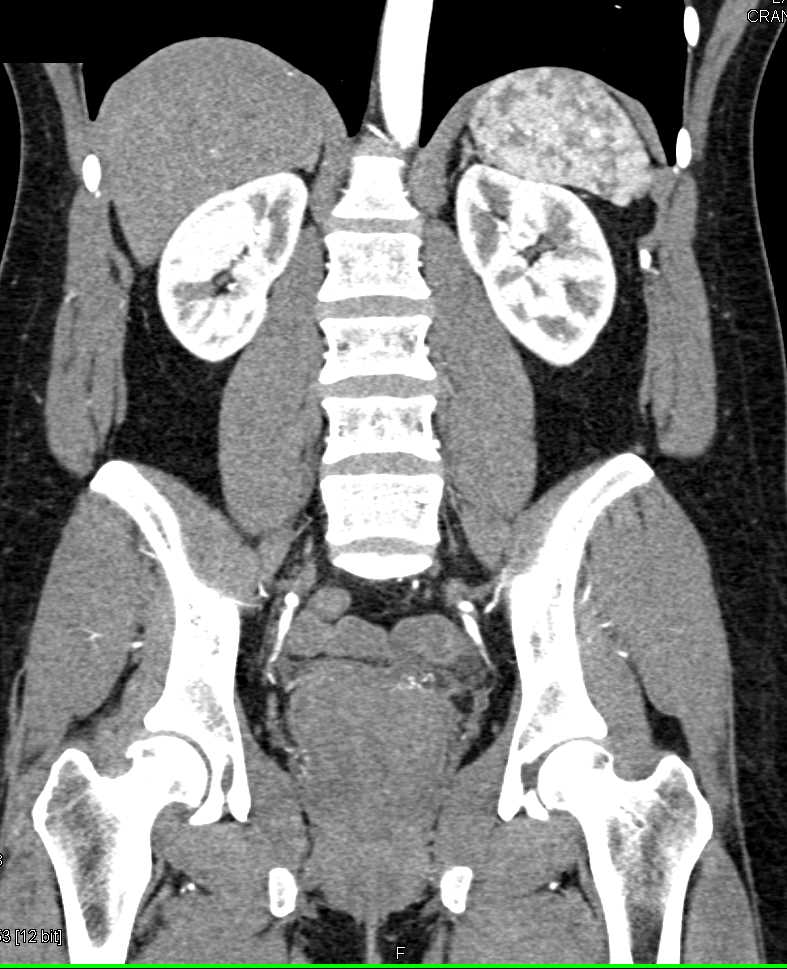 Enlarged Prostate Gland - CTisus CT Scan