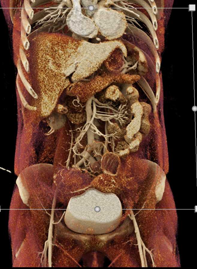 Cinematic Rendering of the Bladder and Ovarian Metastases - CTisus CT Scan