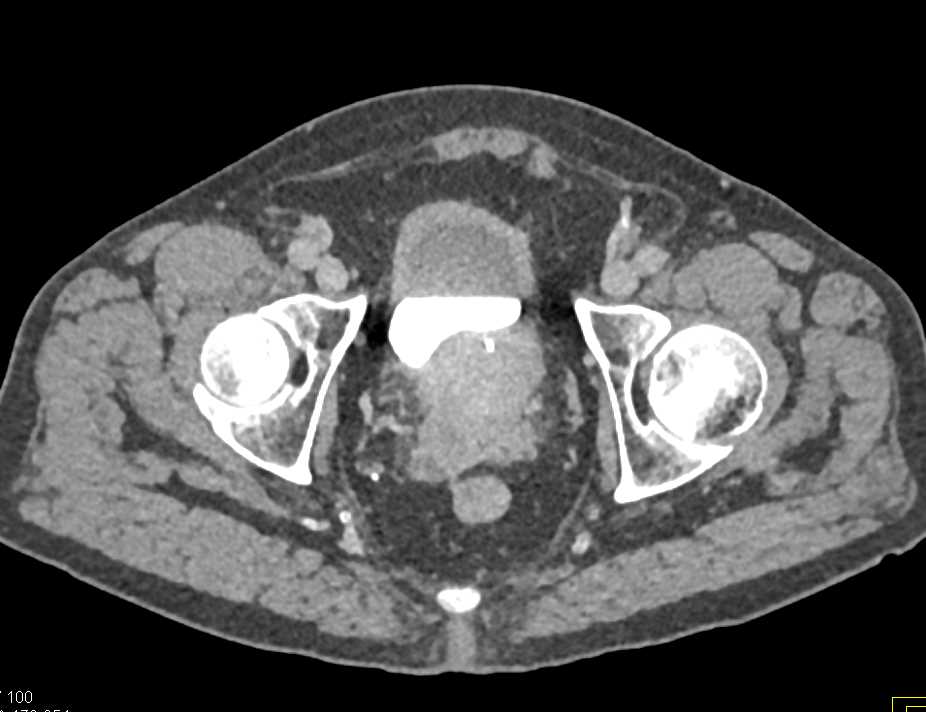 Prostate Cancer Involves the Bladder - CTisus CT Scan