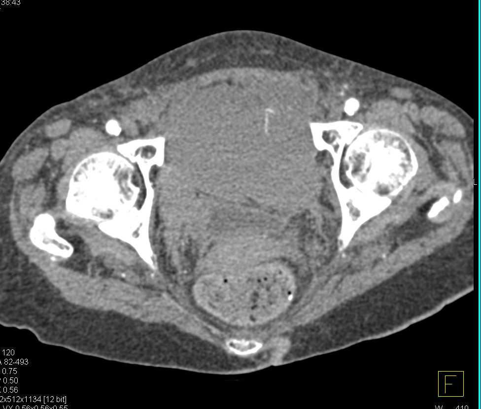 Active Bleed in the Bladder - CTisus CT Scan