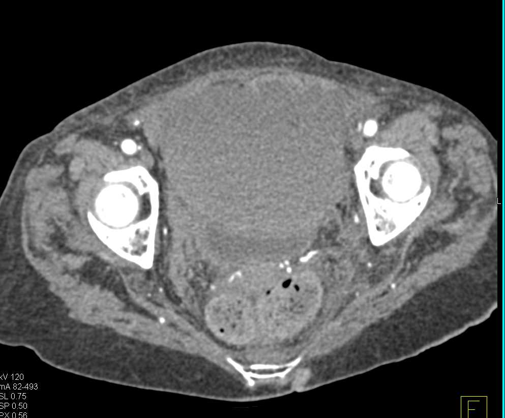Active Bleed in the Bladder - CTisus CT Scan