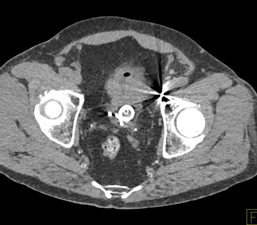 Dilated Renal Pelvises and Ureters with Thickened Wall Bladder - CTisus CT Scan