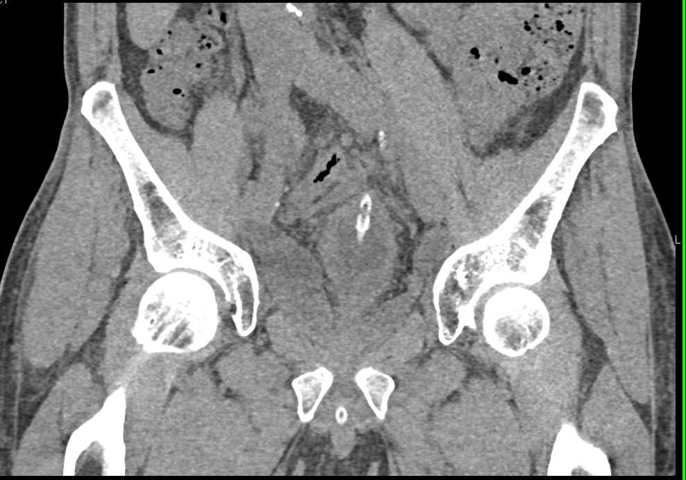 Post Surgery without Bladder Injury - CTisus CT Scan
