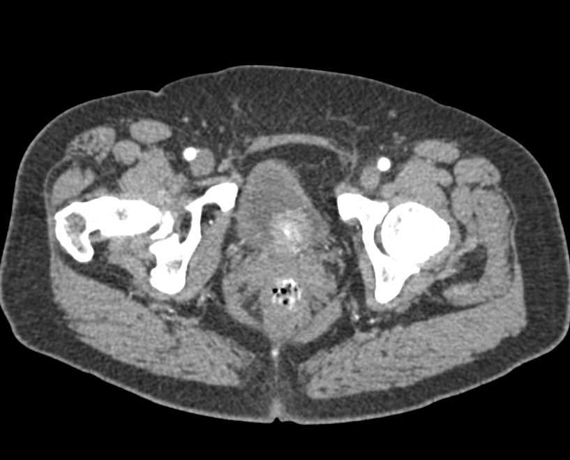 Enhancing Bladder Cancer is a Polypoid Mass - CTisus CT Scan