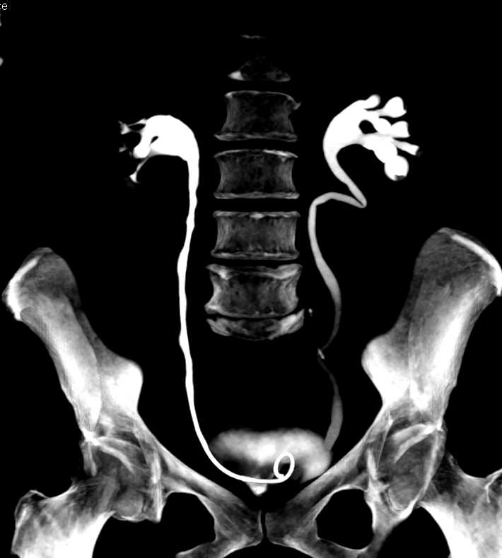 Inflammation Right Ureter - CTisus CT Scan