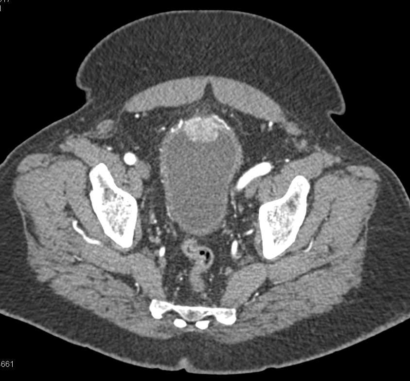 Urachal Carcinoma Bladder - CTisus CT Scan