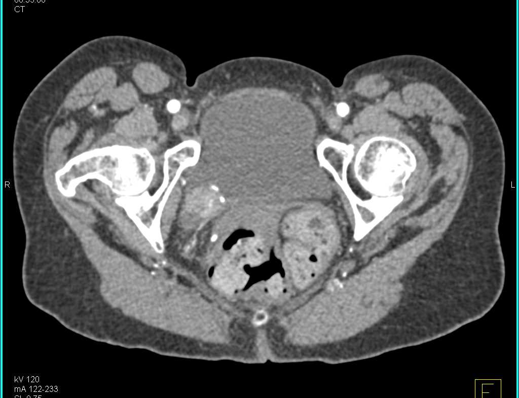 Incidental Bladder Cancer Near Right Ureterovesical Junction (UVJ) - CTisus CT Scan