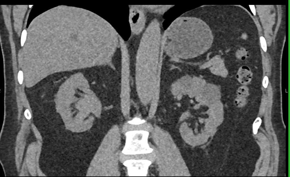 Transitional Cell Carcinoma Right Kidney and Bladder - CTisus CT Scan