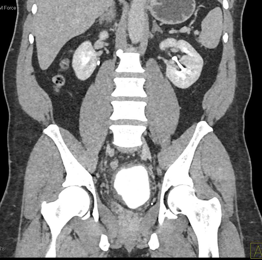 Large Bladder Diverticulum - CTisus CT Scan