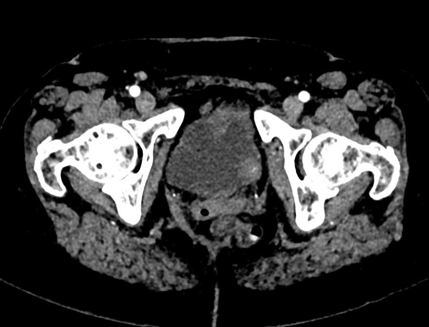 Multifocal Transitional Cell Carcinoma (TCC) of the Bladder - CTisus CT Scan