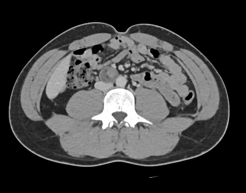 Germ Cell Tumor - CTisus CT Scan