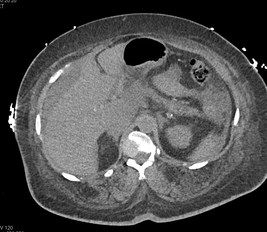 CT Cystogram with Leak - CTisus CT Scan