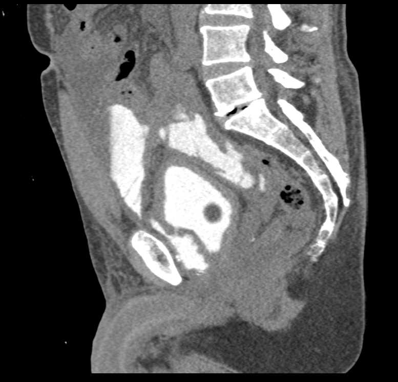 Bladder Cancer with Adenopathy - CTisus CT Scan
