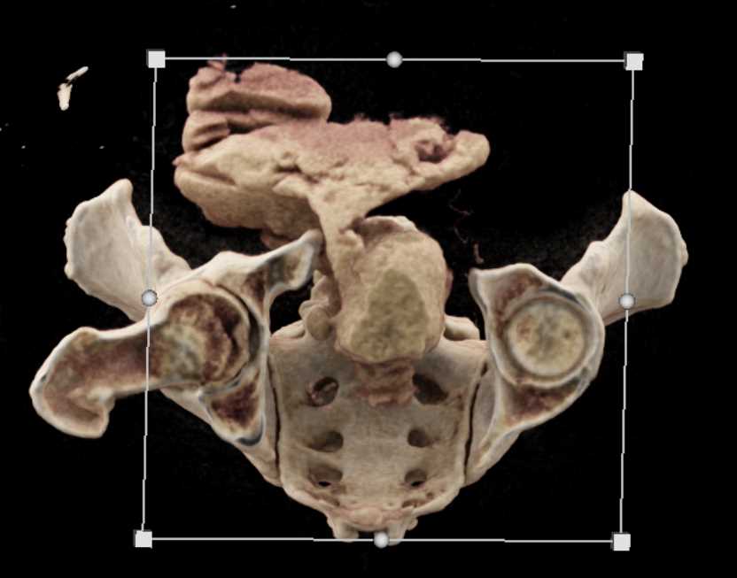 Bladder Cancer with Adenopathy and Leak - CTisus CT Scan