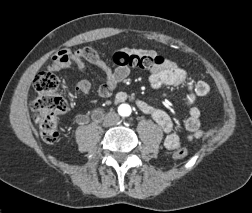 Right Sided Bladder Cancer - CTisus CT Scan