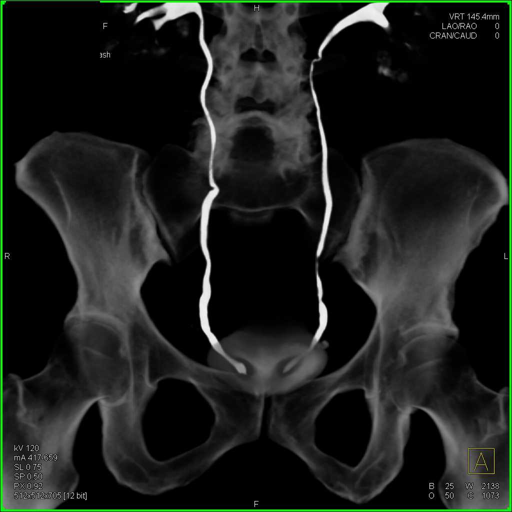 CT urogram with Ureterocles - CTisus CT Scan