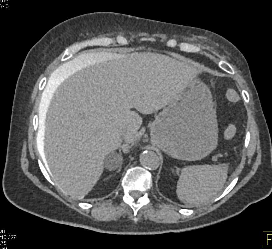 Bladder Rupture with Contrast Extravasation in the Abdomen - CTisus CT Scan