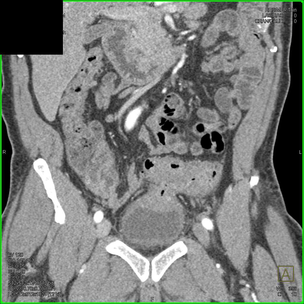 Colovesicle Fistulae - CTisus CT Scan