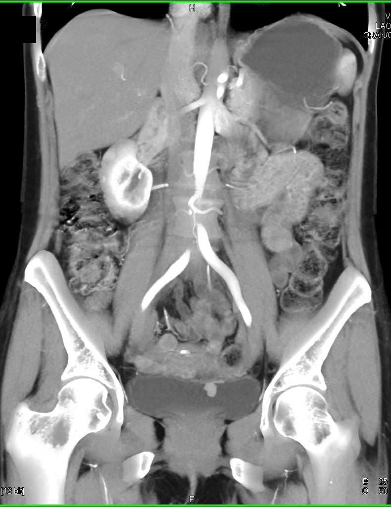 Bladder Cancer with Active Bleed - CTisus CT Scan