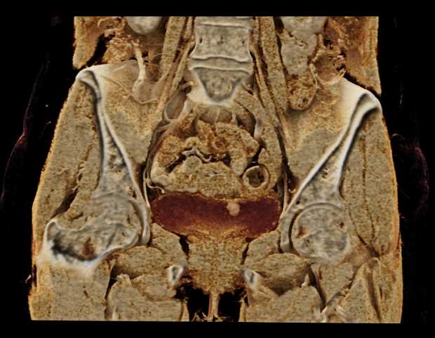 Bladder Cancer with Active Bleed - CTisus CT Scan