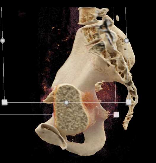 Urachal Carcinoma of the Bladder - CTisus CT Scan