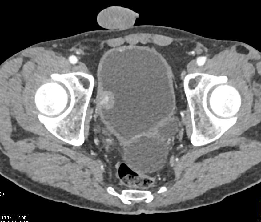 Bladder Cancer - CTisus CT Scan