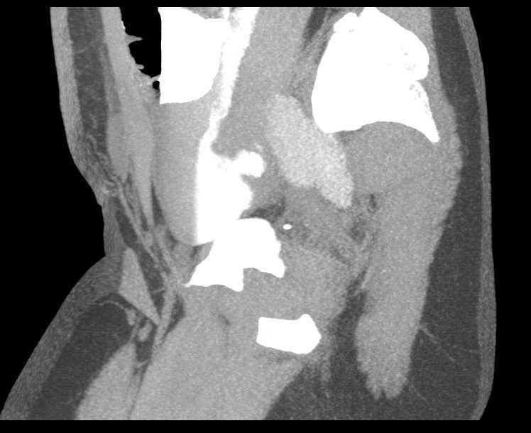 Bladder Leak on CT Cystogram - CTisus CT Scan