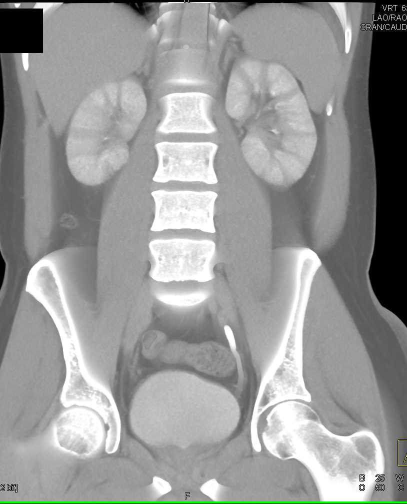 Striated Nephrograms due to Hypotension - CTisus CT Scan