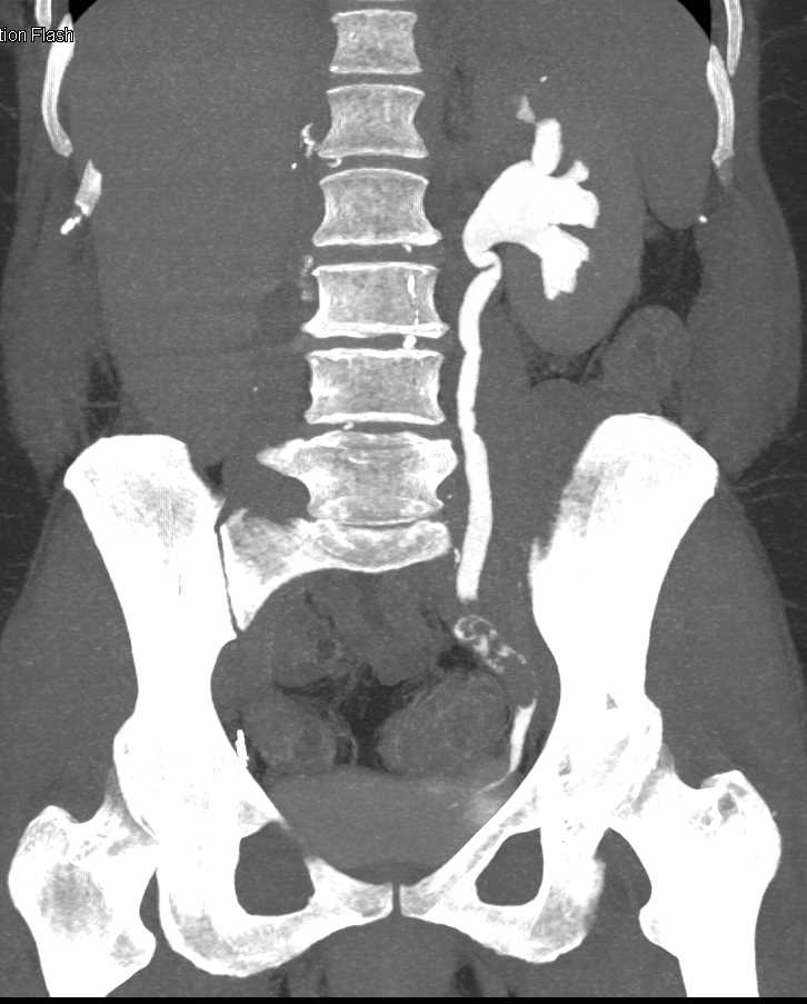 Transitional Cell Carcinoma (TCC) Distal Left Ureter - CTisus CT Scan