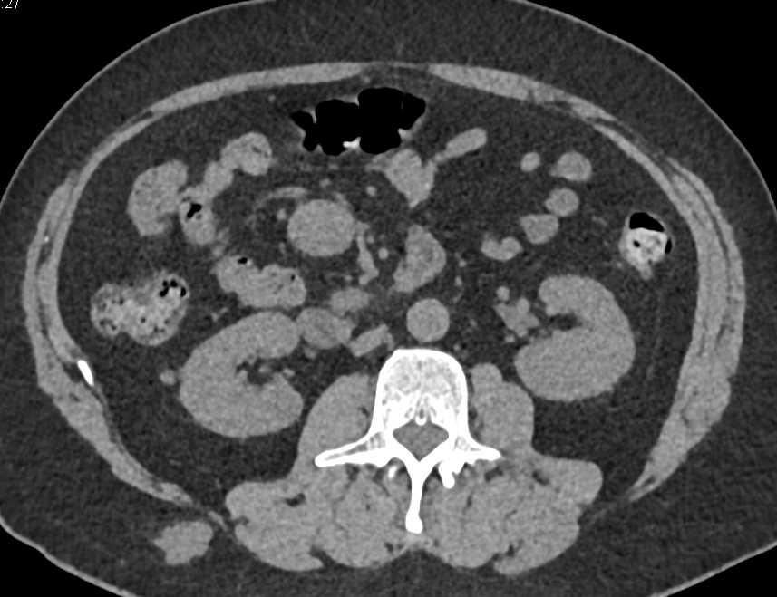 Bladder Cancer with Lung Metastases - CTisus CT Scan