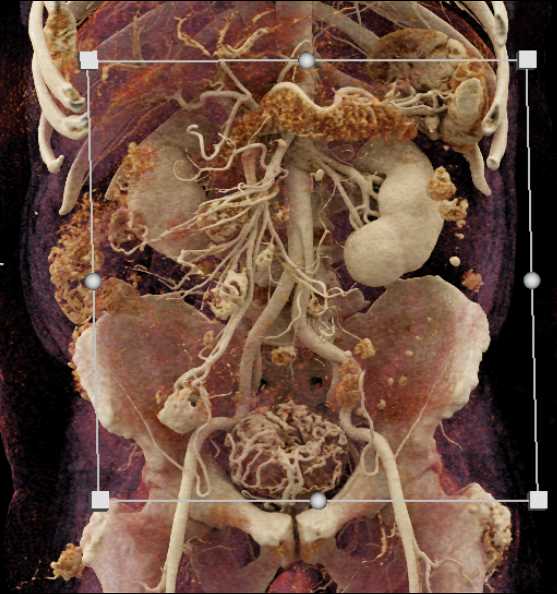 Bladder Cancer with Lung Metastases - CTisus CT Scan