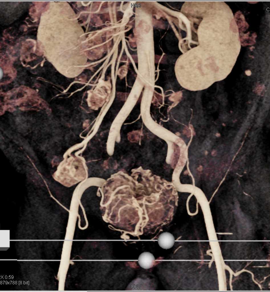 Vascular Bladder Cancer with Lung Metastases - CTisus CT Scan