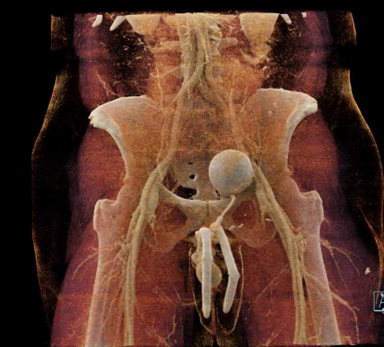 Penile Prosthesis - CTisus CT Scan