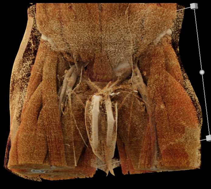 Penile Prosthesis with CR - CTisus CT Scan