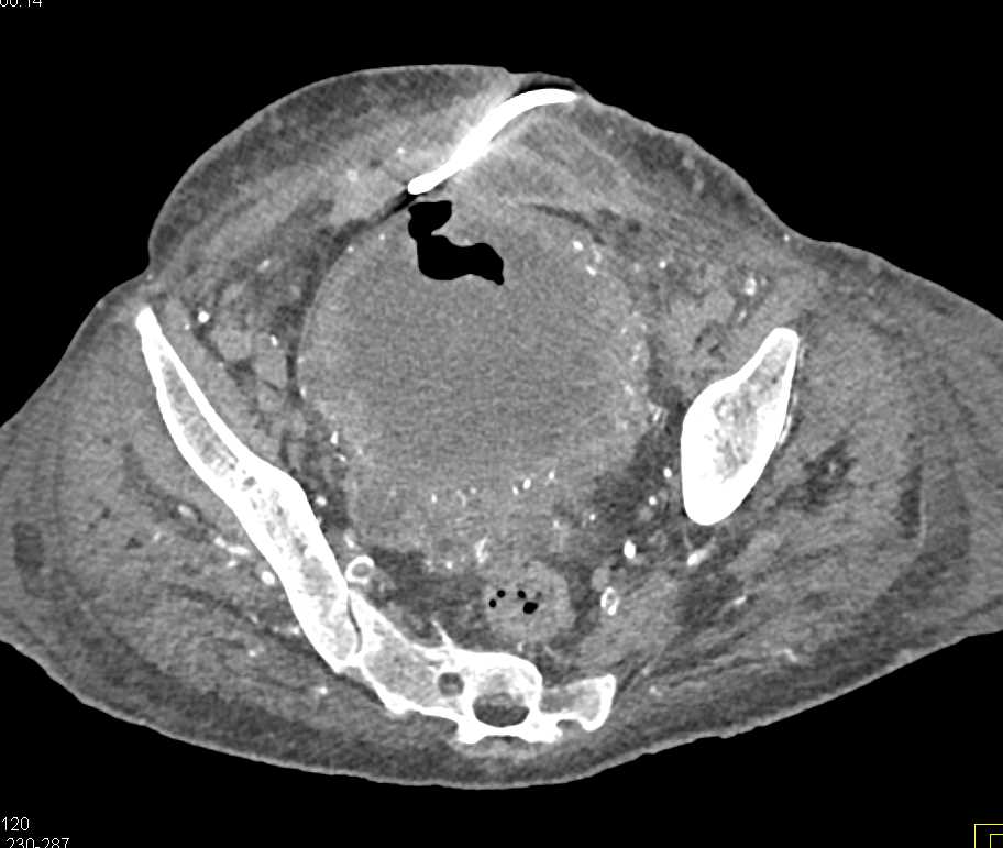 Aggressive Bladder Cancer - CTisus CT Scan