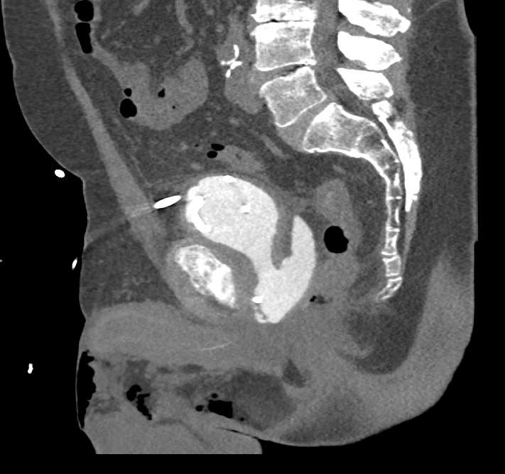 CT Cystogram with Leak - CTisus CT Scan