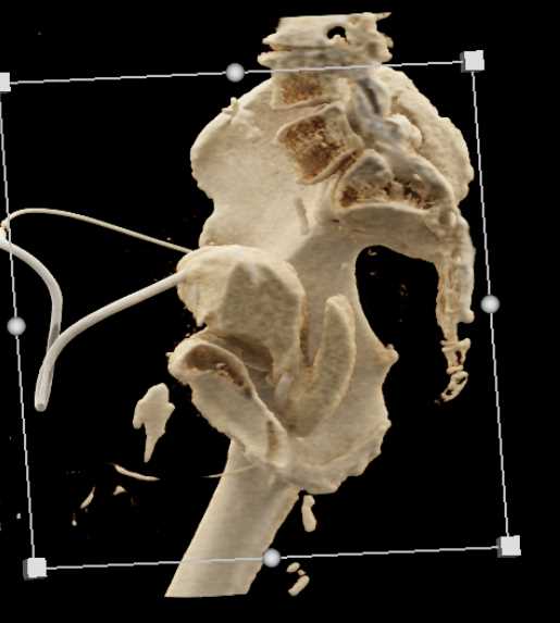CT Cystogram with Leak - CTisus CT Scan