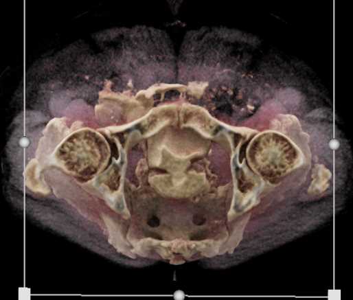 CT Cystogram with Leak - CTisus CT Scan