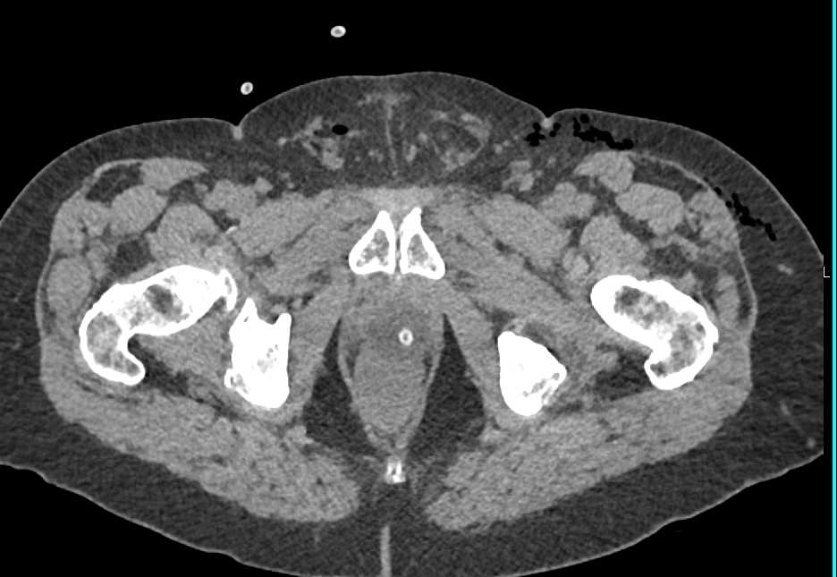 CT Cystogram with Leak - CTisus CT Scan