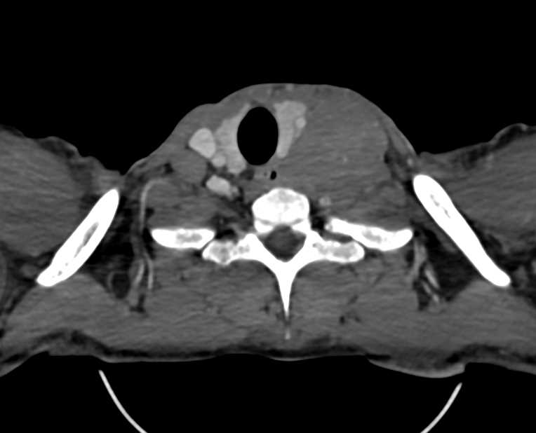 Testicular Seminoma - CTisus CT Scan