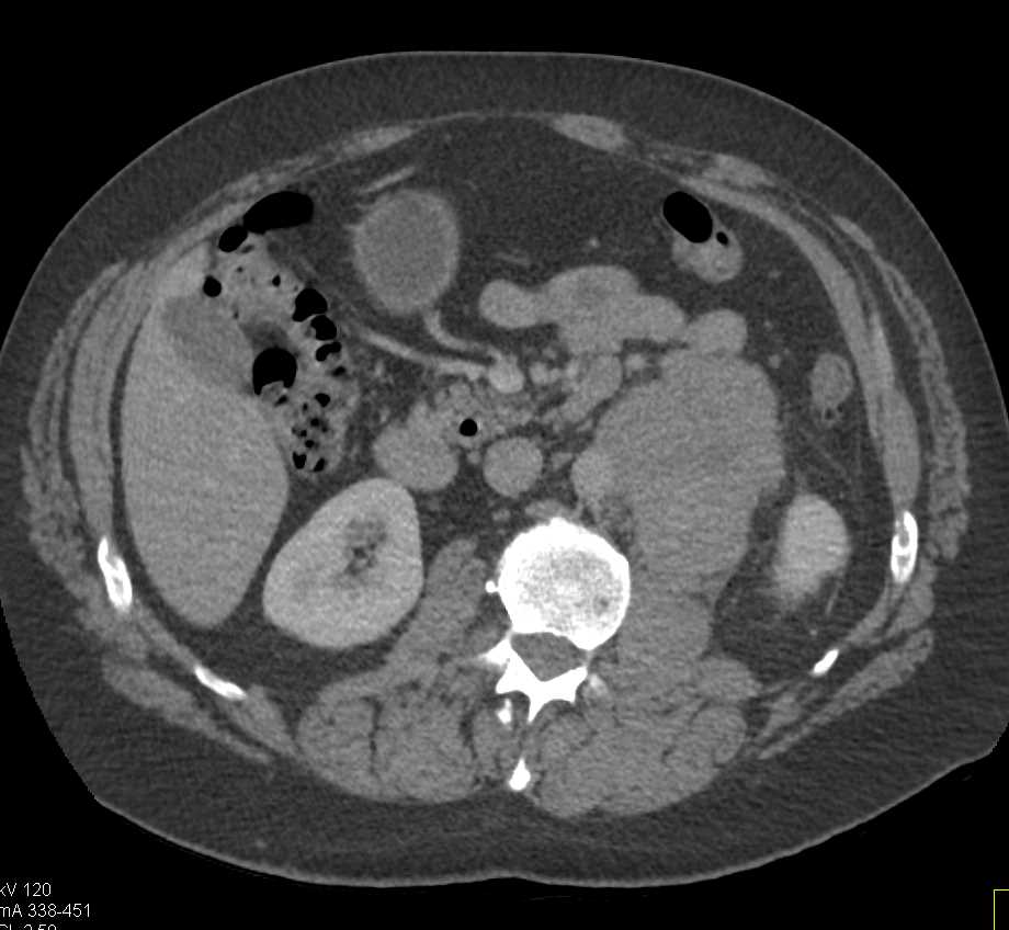Testicular Cancer with Adenopathy - CTisus CT Scan