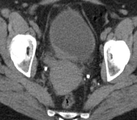 Malakoplakia - CTisus CT Scan