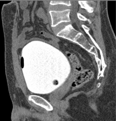Ct Cystogram - CTisus CT Scan