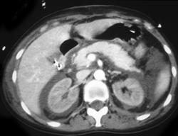 Acute Renal Failure - CTisus CT Scan