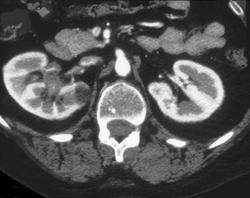 Transitional Cell Cancer (TCC) of Right Kidney - CTisus CT Scan
