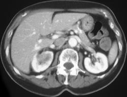 Lung Cancer Metastatic to the Rt Kidney - CTisus CT Scan