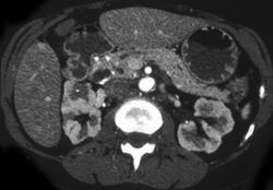 Scarred Kidneys - CTisus CT Scan