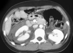 Renal and Adrenal Trauma - CTisus CT Scan